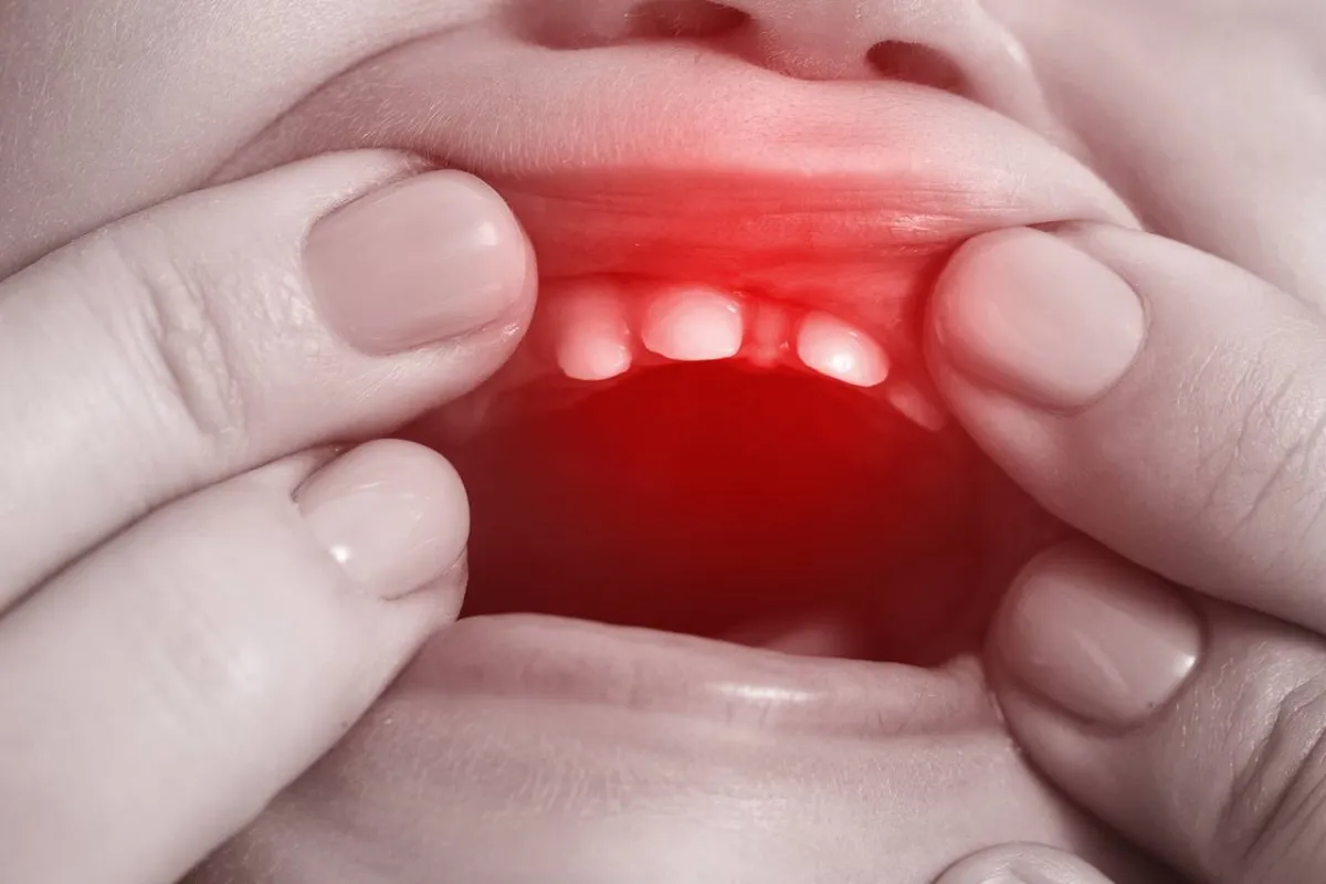 صورة لأسنان الطفل