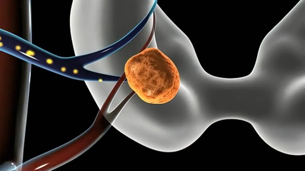 صورة لانغراس البويضة