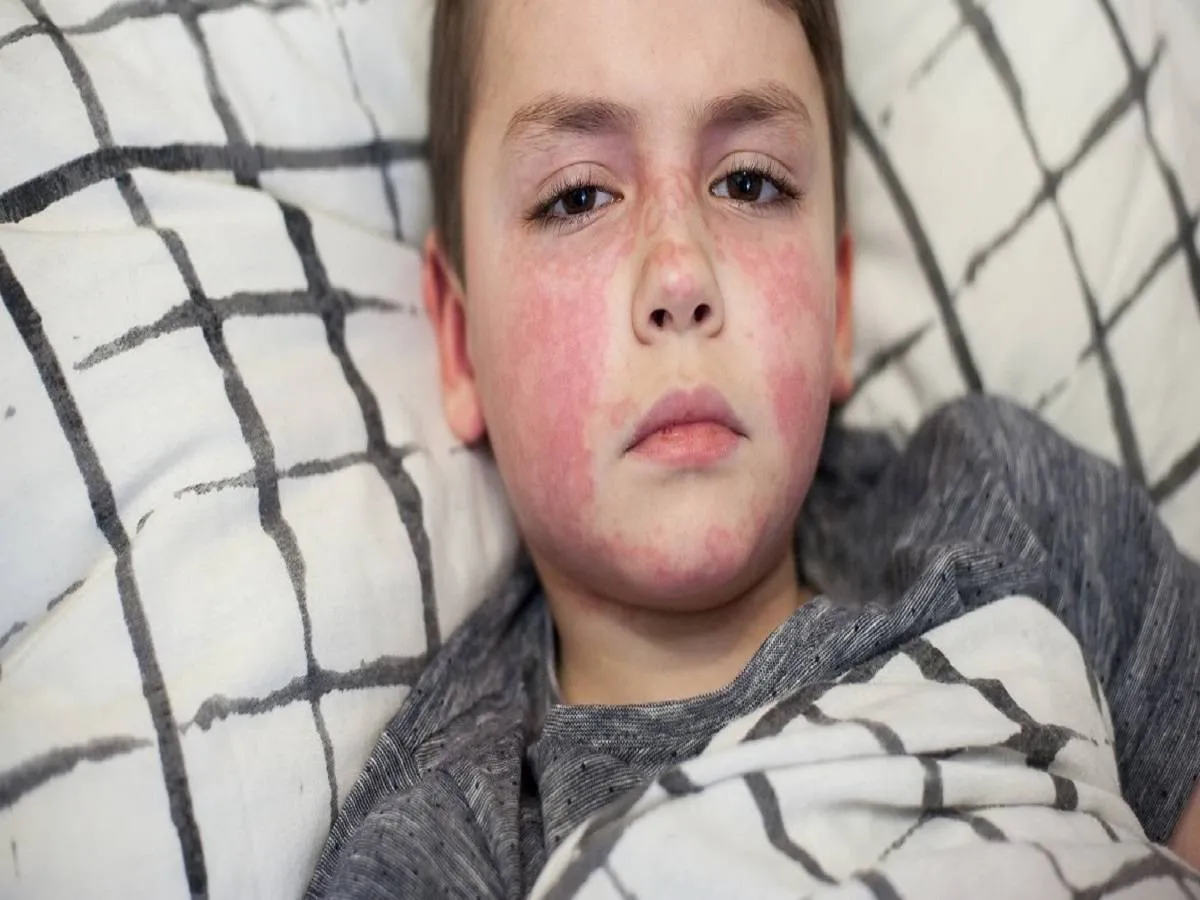 صورة لطفل يعاني من طفح جلدي