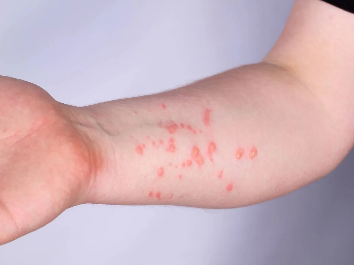 صورة لطفح جلدي