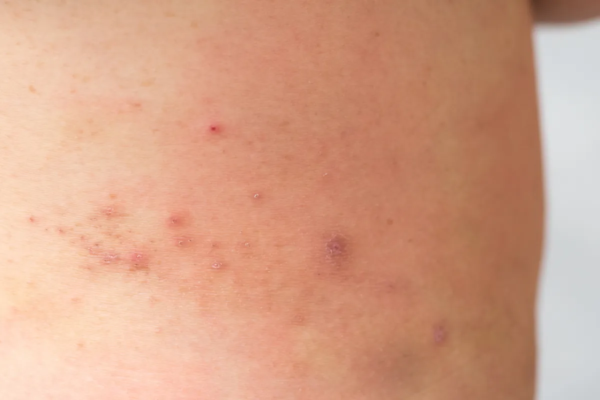 صورة للطفح الجلدي