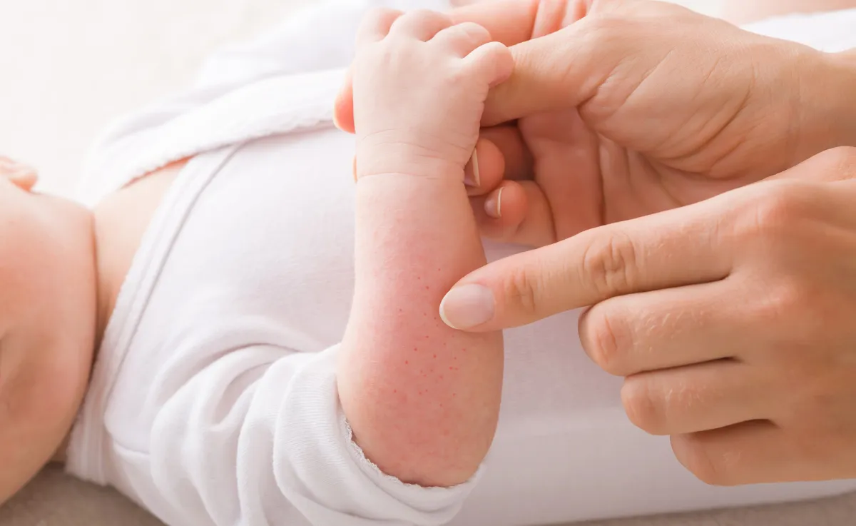 أسباب انتشار حبوب صغيرة في جسم طفلي