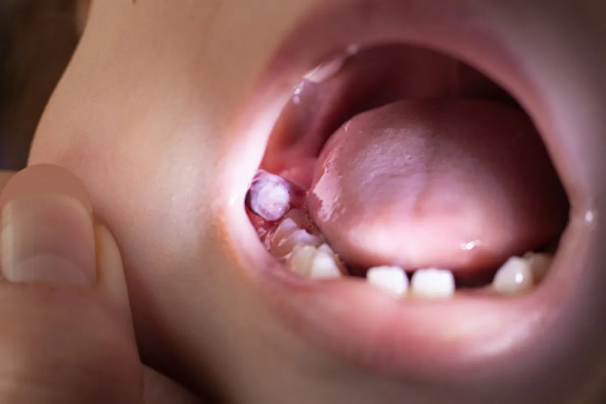 صورة لطفل يعاني من مرحلة التسنين