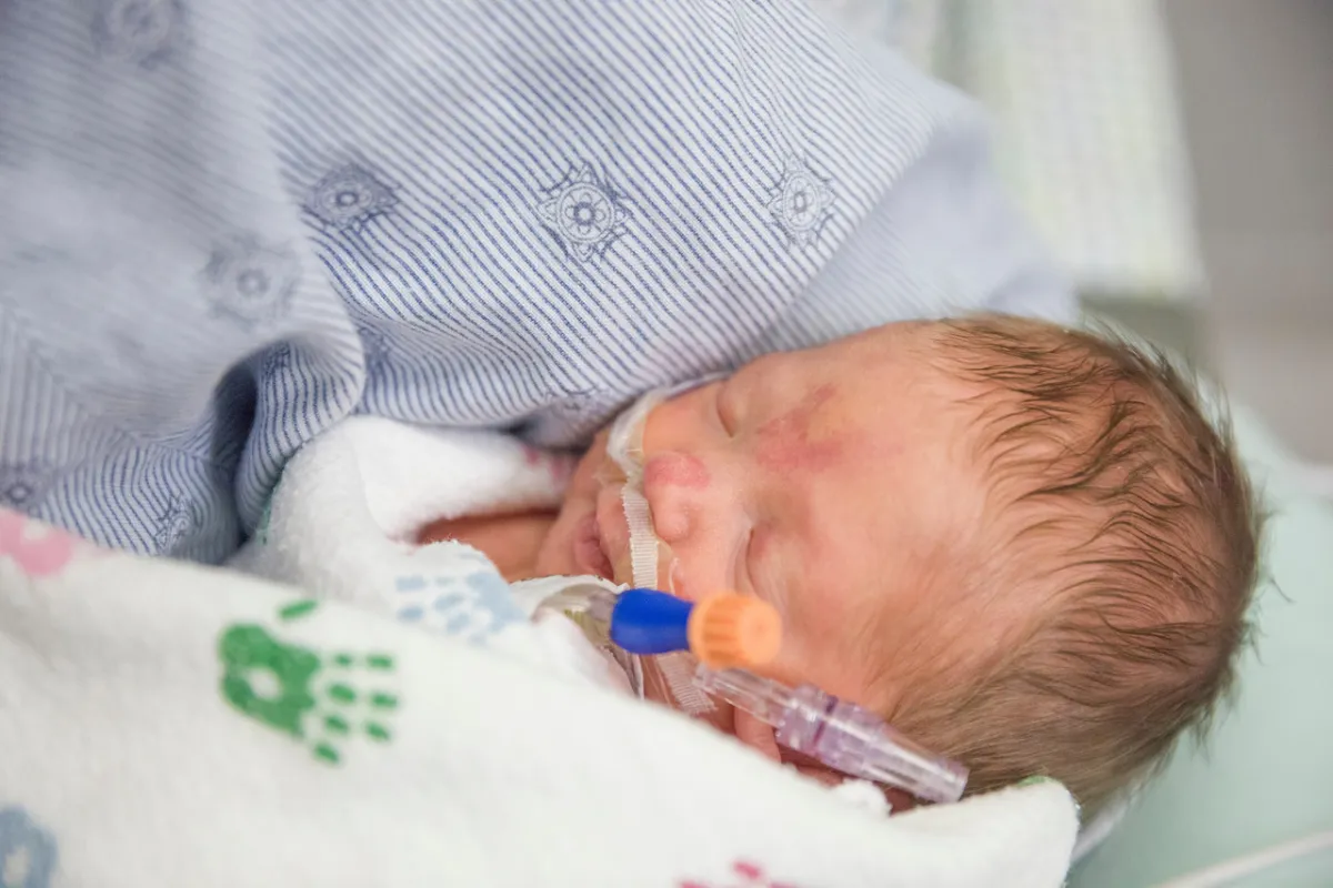 صورة للولادة المبكرة