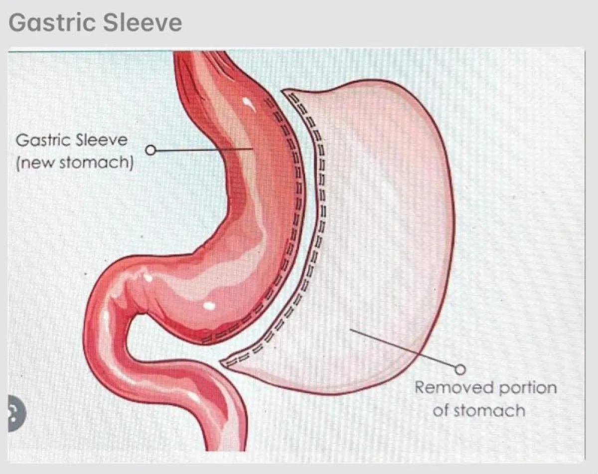 عملية تكميم المعدة