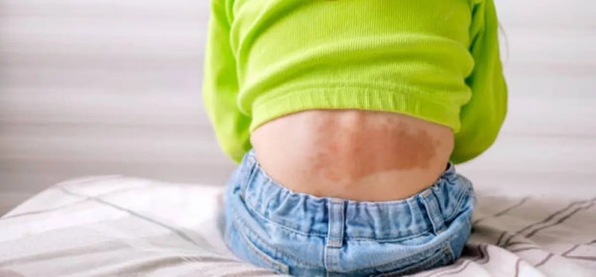 صورة للبقع المنغولية