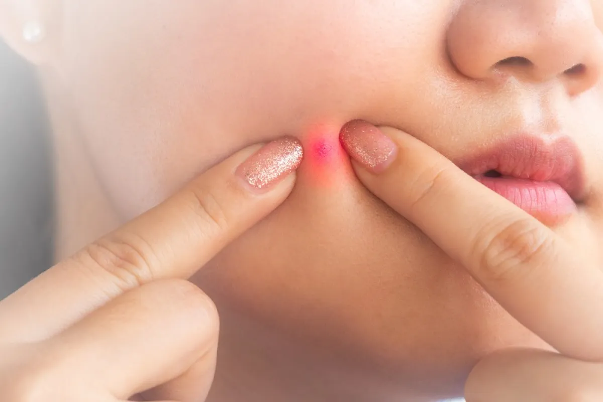 طرق علاج حب الشباب