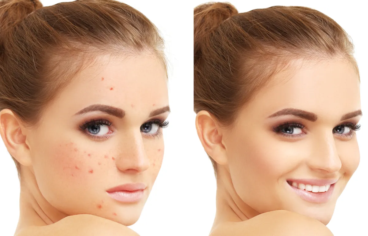 علاج حب الشباب بالثوم