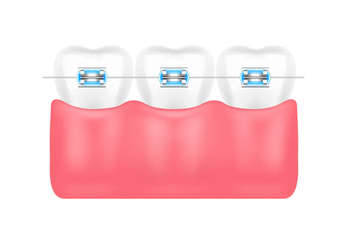 صورة لطحن الأسنان