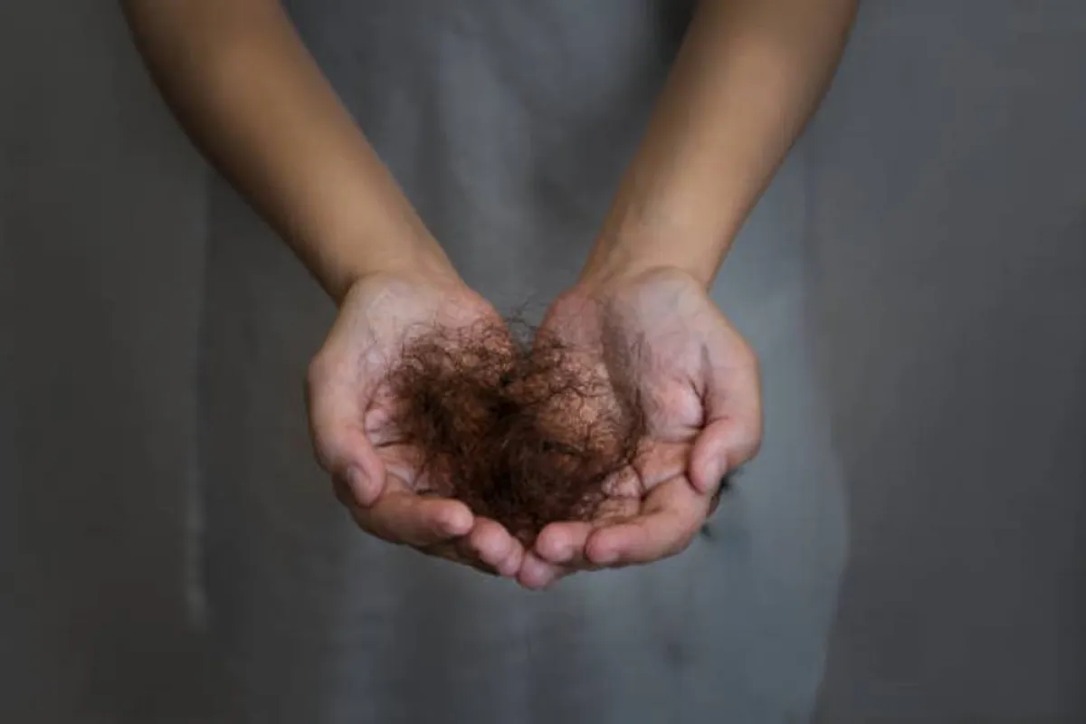 صورة تعبر عن تشاقط الشعر لنقص الحديد