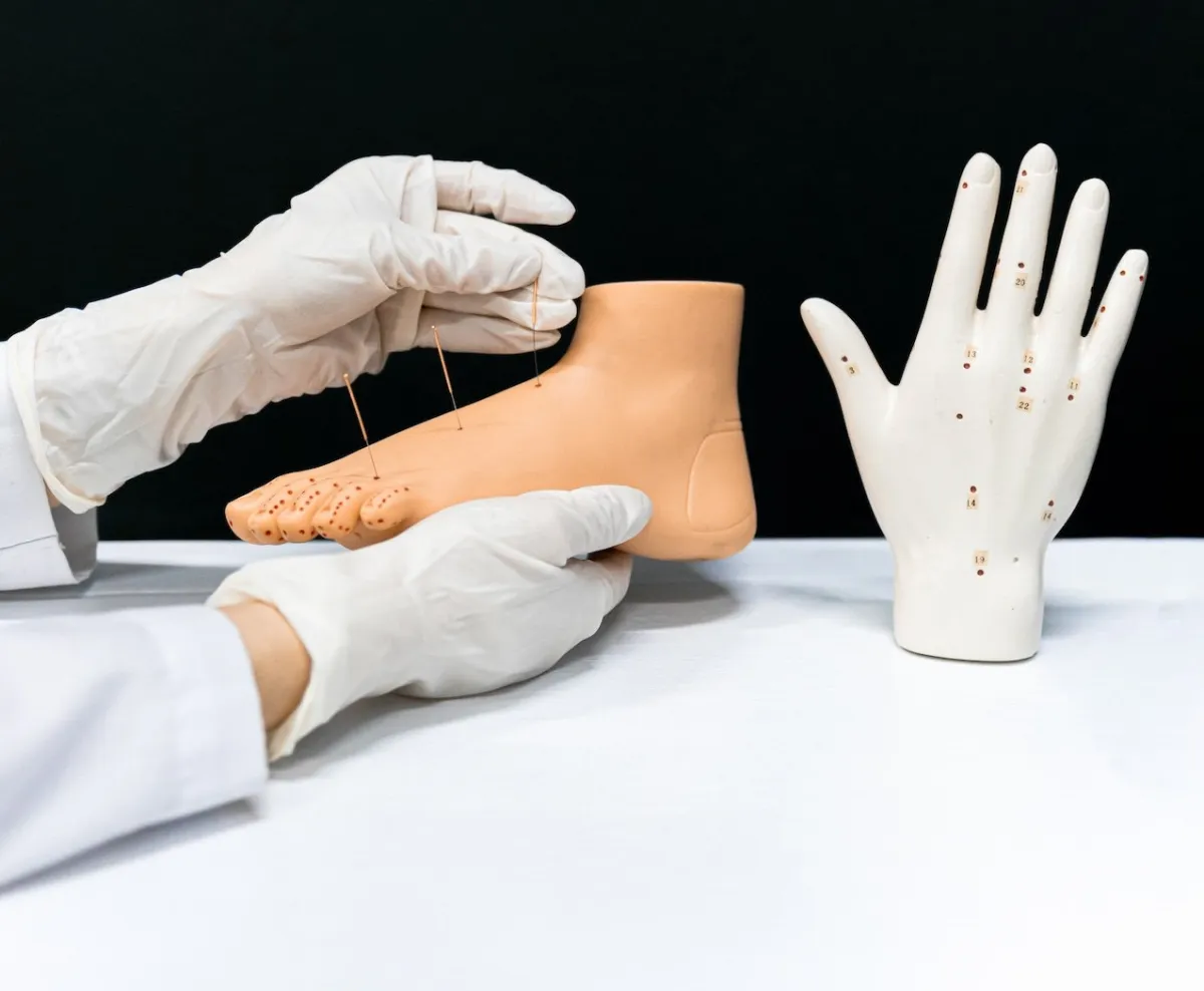 صورة للوخز بالإبر