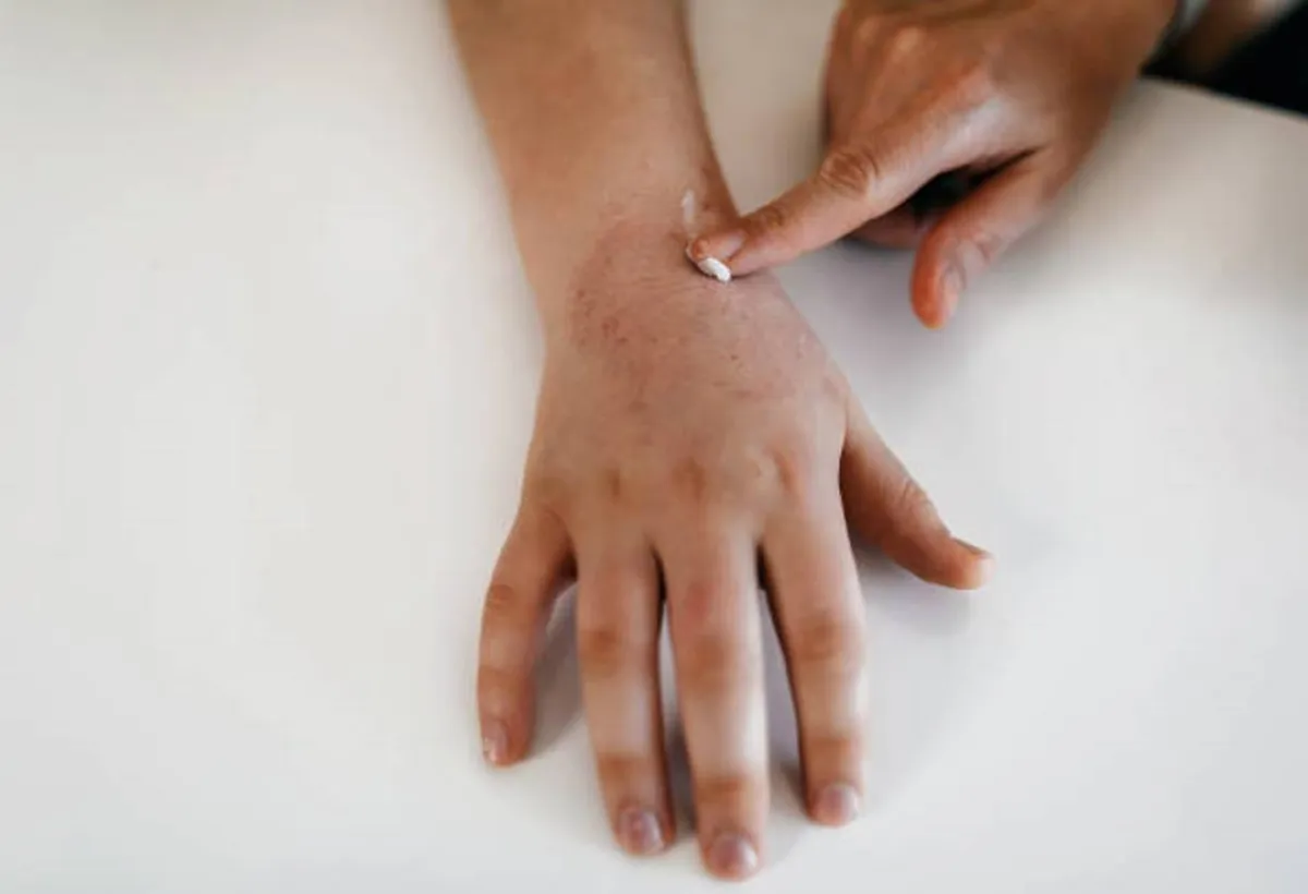 صورة لجلد يعاني من الجفاف في مرحلة متقدمة