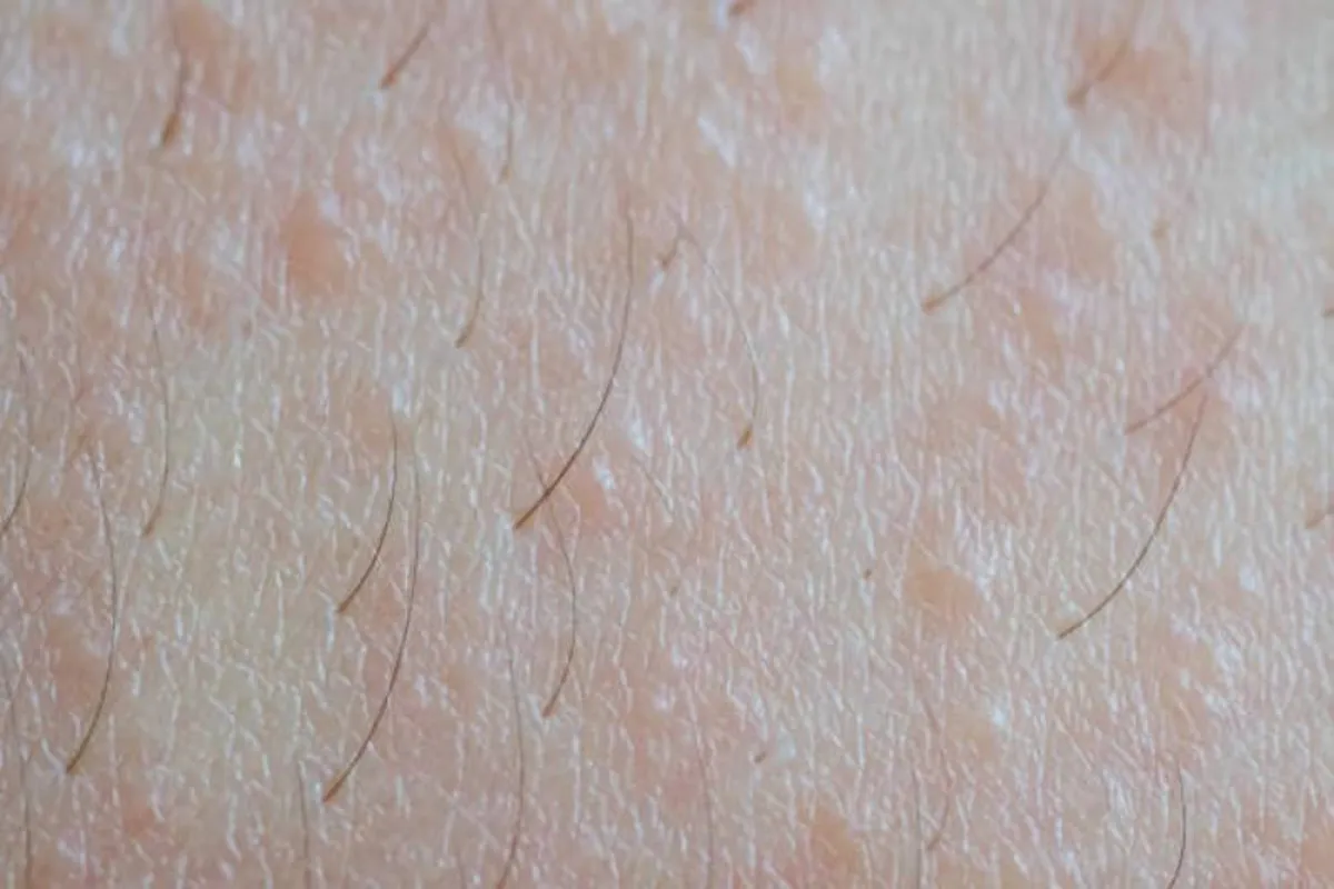 صورة تشير لفقدان الجلد رطوبته