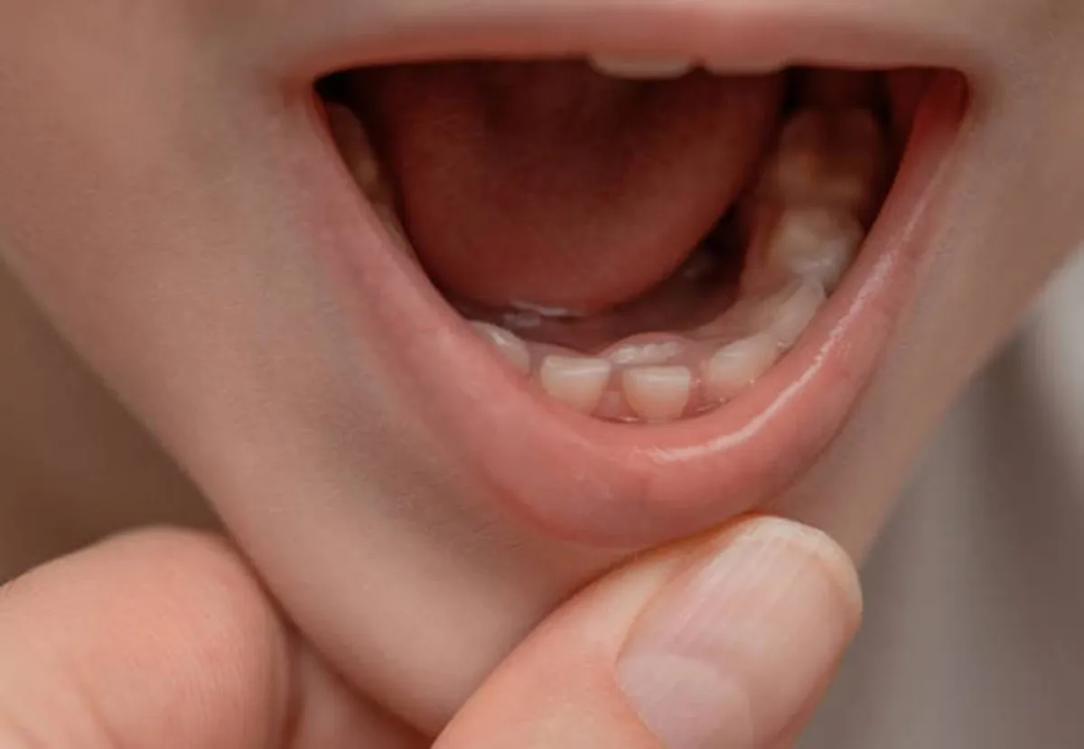 صورة تشير للتسنين المختلط