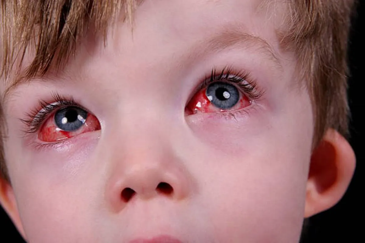 صورة لعيني طفل يعاني من احمرار مع أعراض أخرى مقلقة
