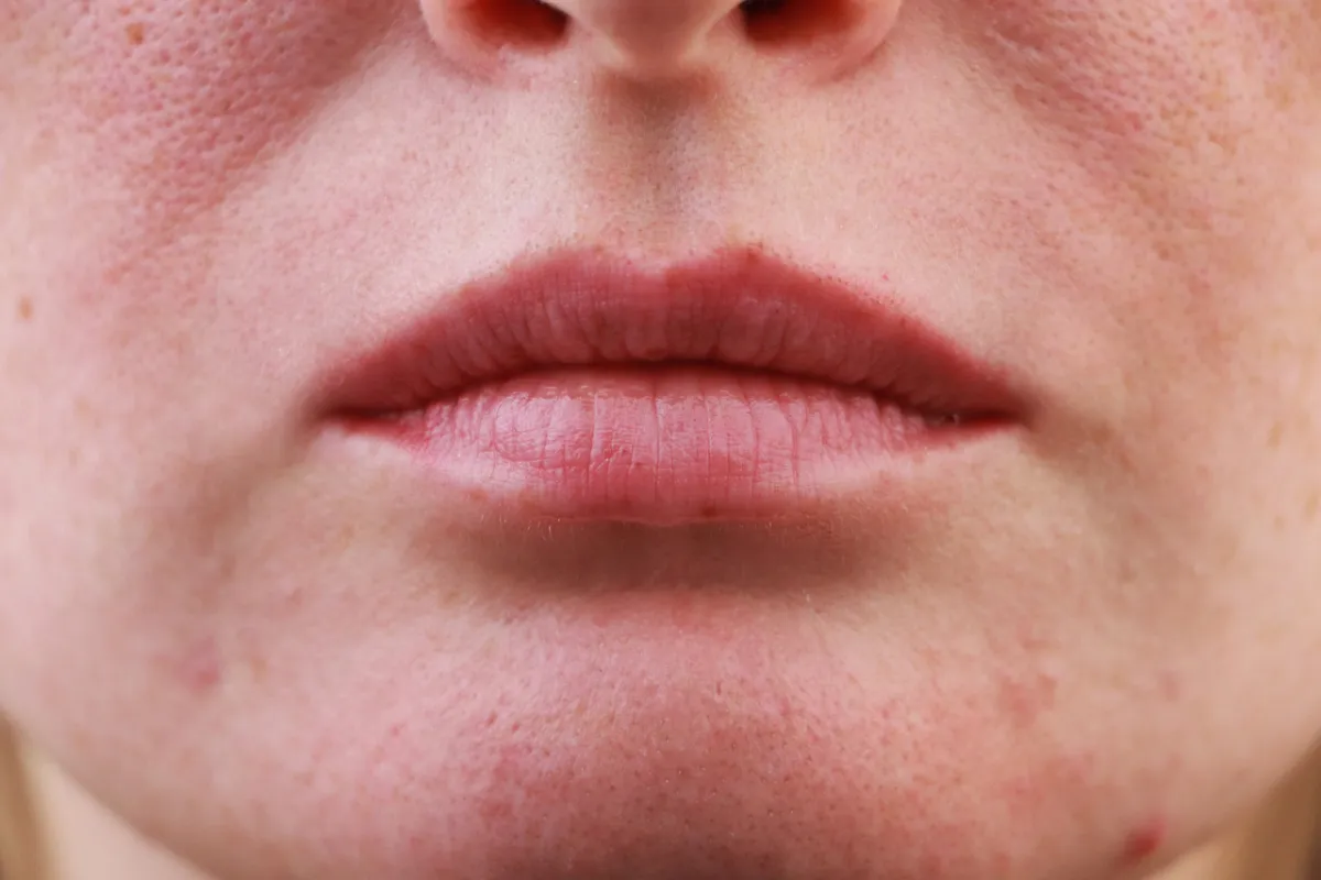 صورة لبشرة دهنية