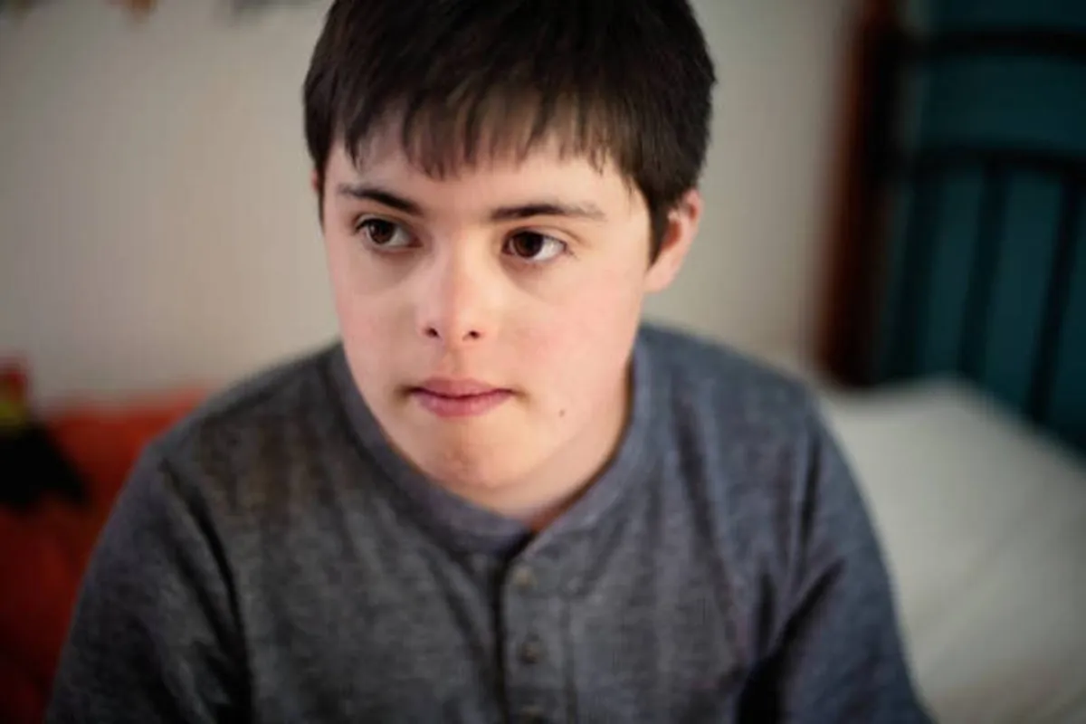 صورة لطفل منغولي لديه ملامح مختلفة عن الطفل الطبيعي