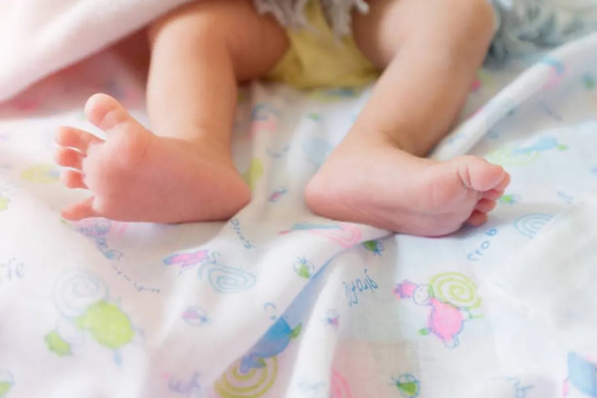 صورة لمولود يعاني من الهزال