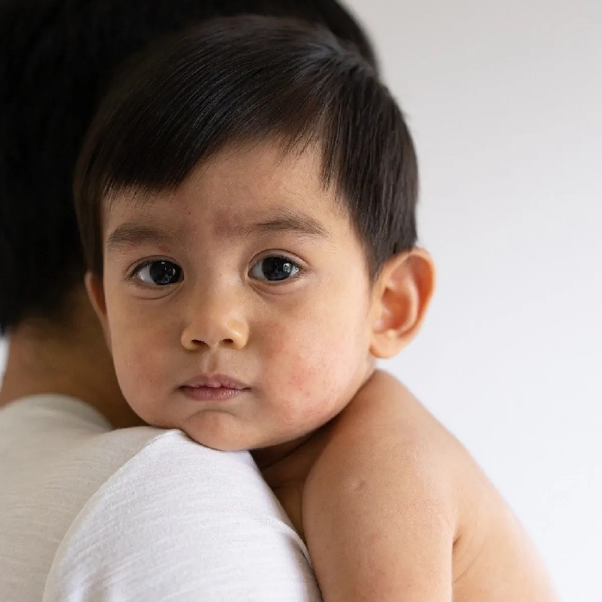 صورة لطفل يعاني من حك الوجه