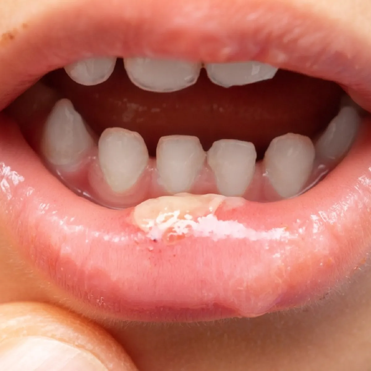 صورة تعبيرية للتقرح على اللثة