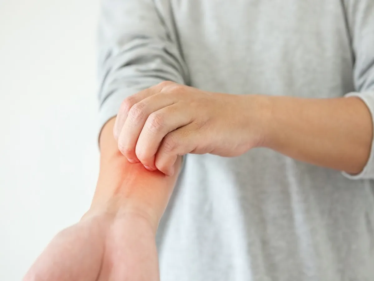 رجل مصاب بالجذام السلي يعاني من بقع جلدية مسطحة أو مرتفعة قليلاً (المصدر: Adobe.Stock)