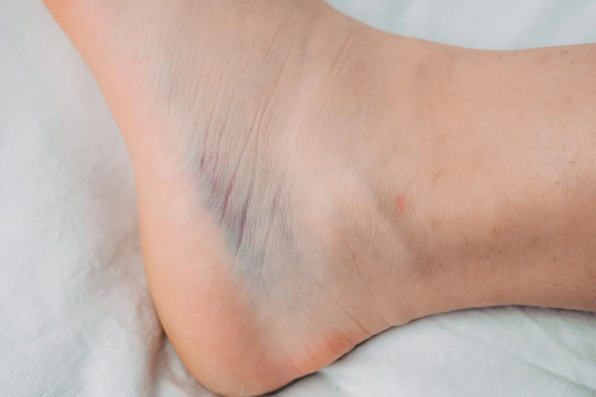 يؤدي نقص الصفائح الدموية إلى ظهور كدمات في الجسم وبقع (المصدر: Adobe.Stock)