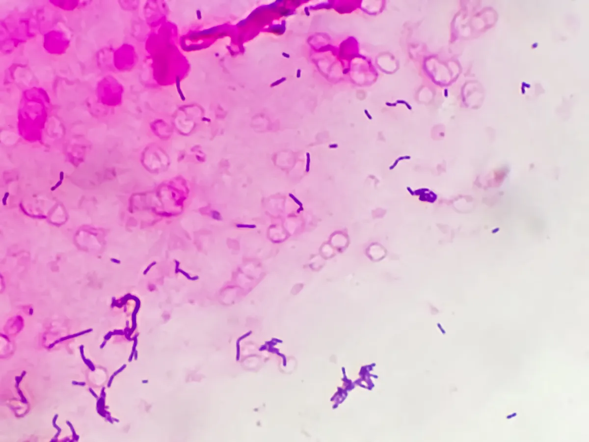 صورة الالتهابات العقدية