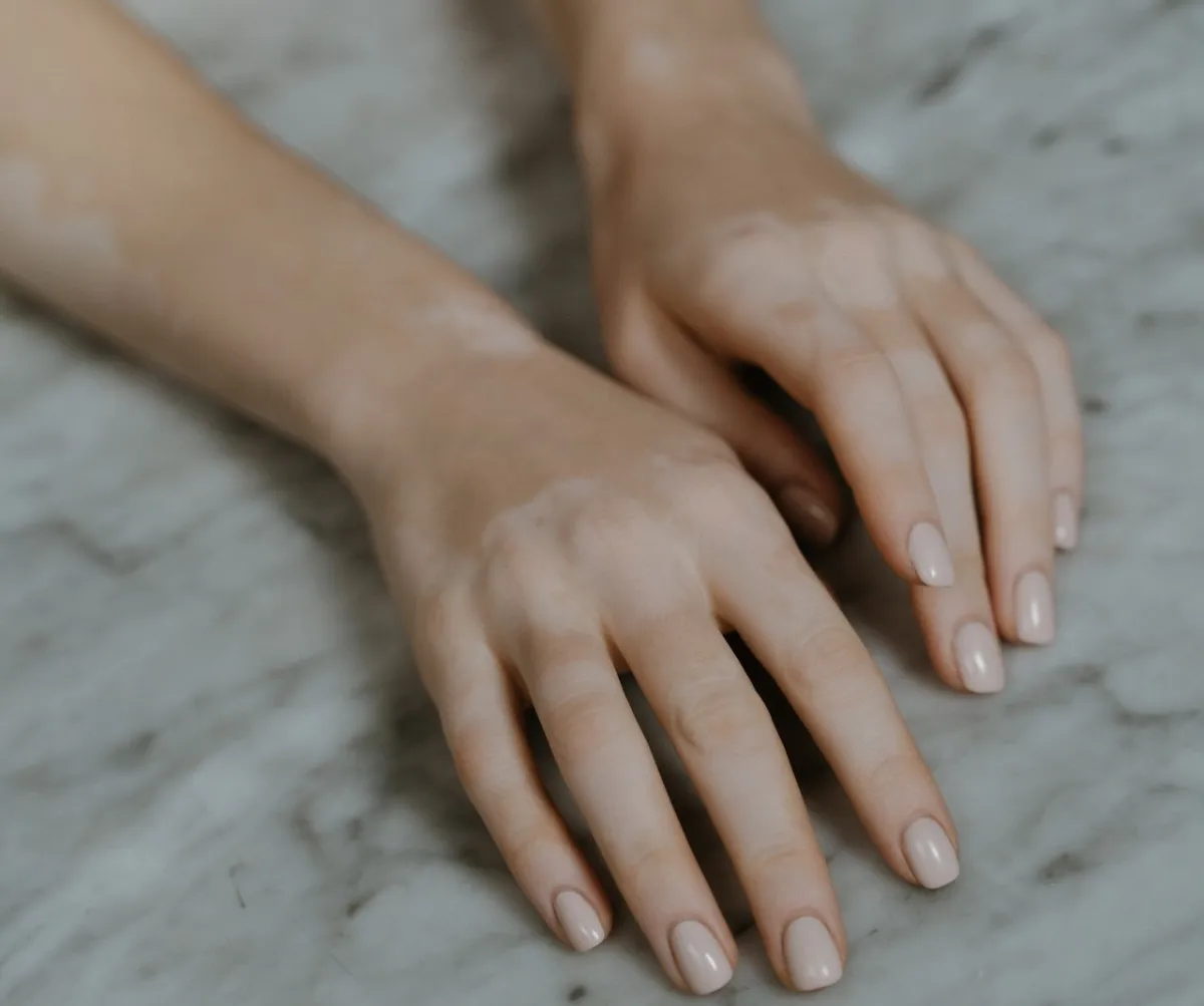 علاج البهاق بات متوفراً (المصدر: Pexels)