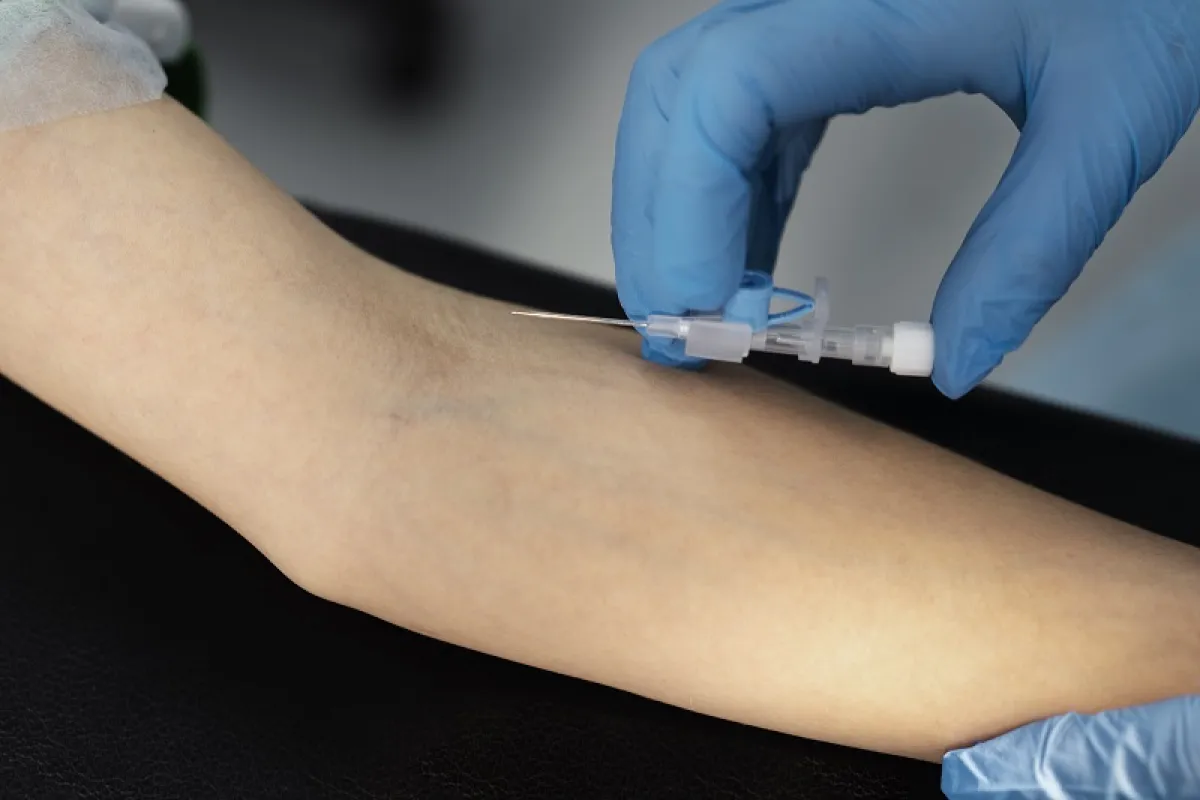 علاج الأوردة