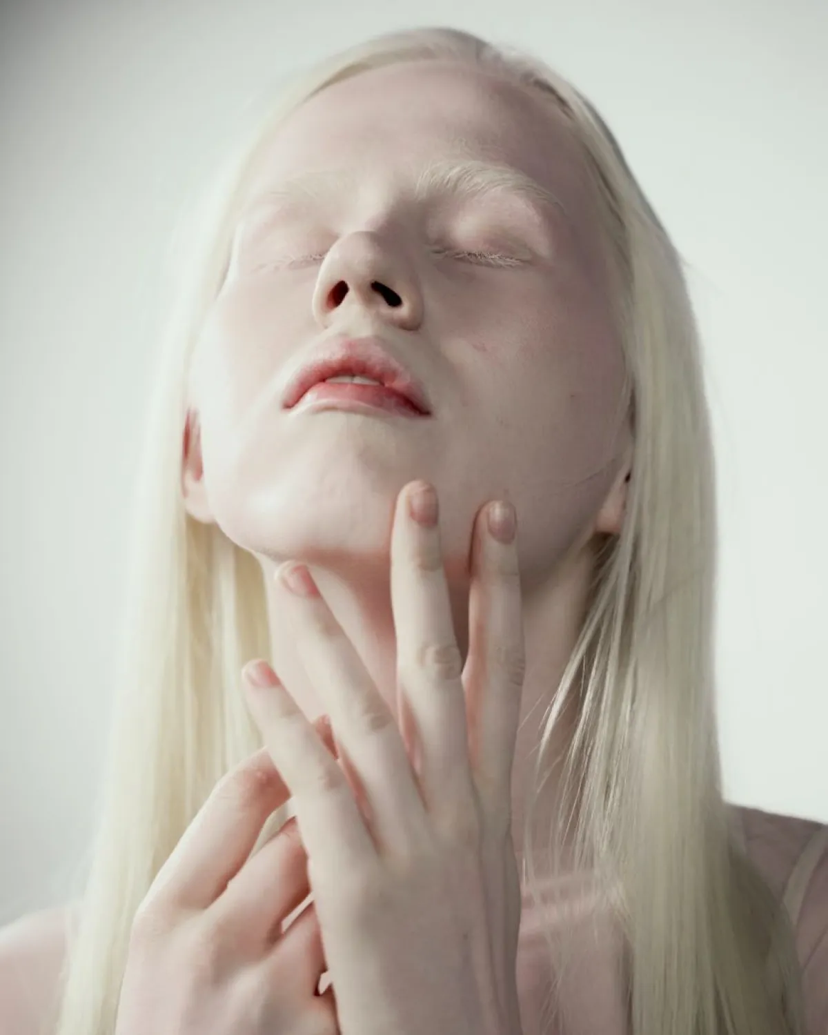 الاحتفال باليوم الدولي للتوعية بالمهق 