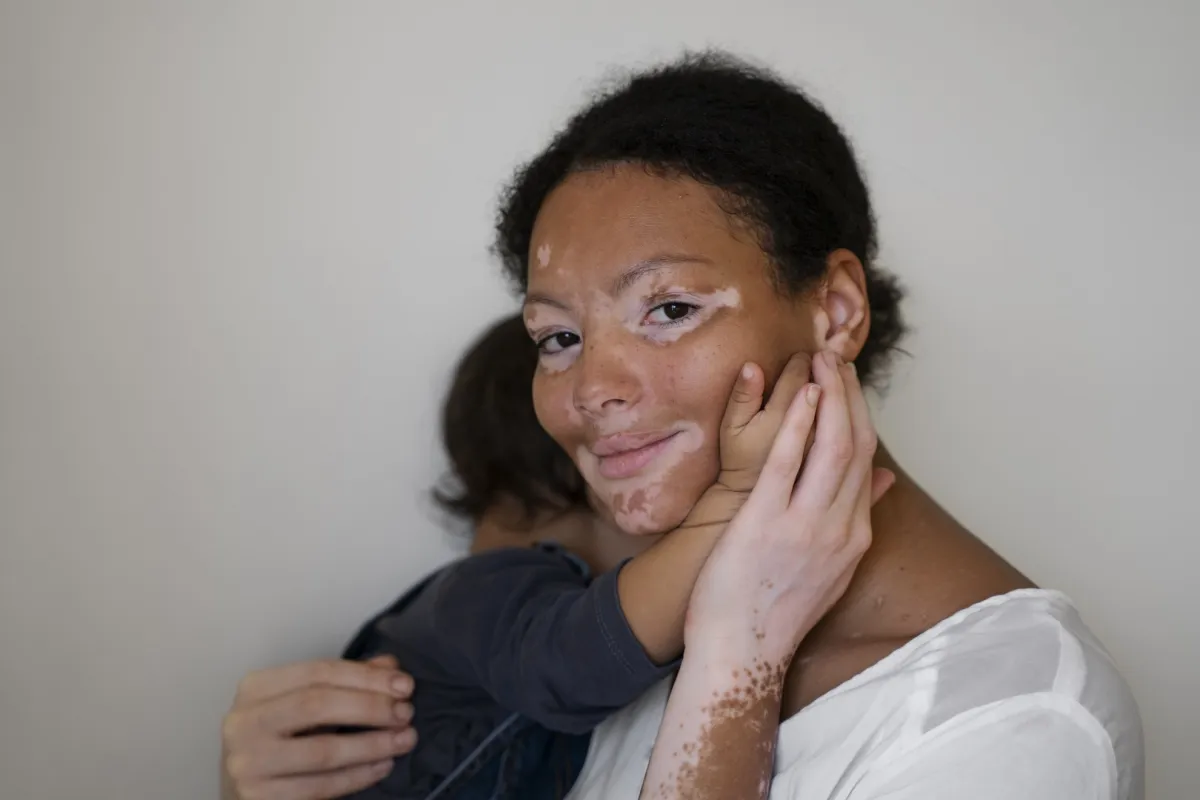 تساعد الكريمات التي تحتوي على مركبات الكورتيكوستيرويد في استعادة الصبغة في البقع البيضاء الصغيرة الناتجة عن البهاق (المصدر: Freepik)