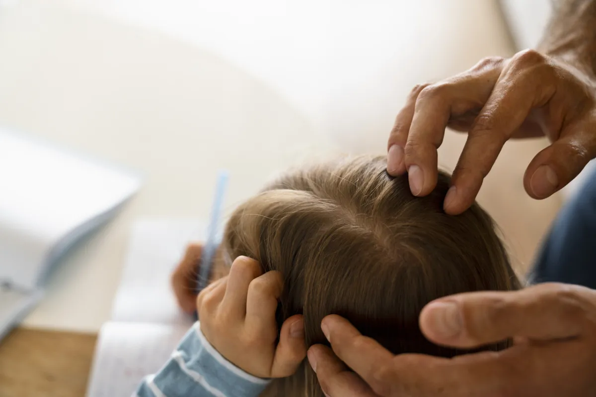 صورة سعفة الرأس