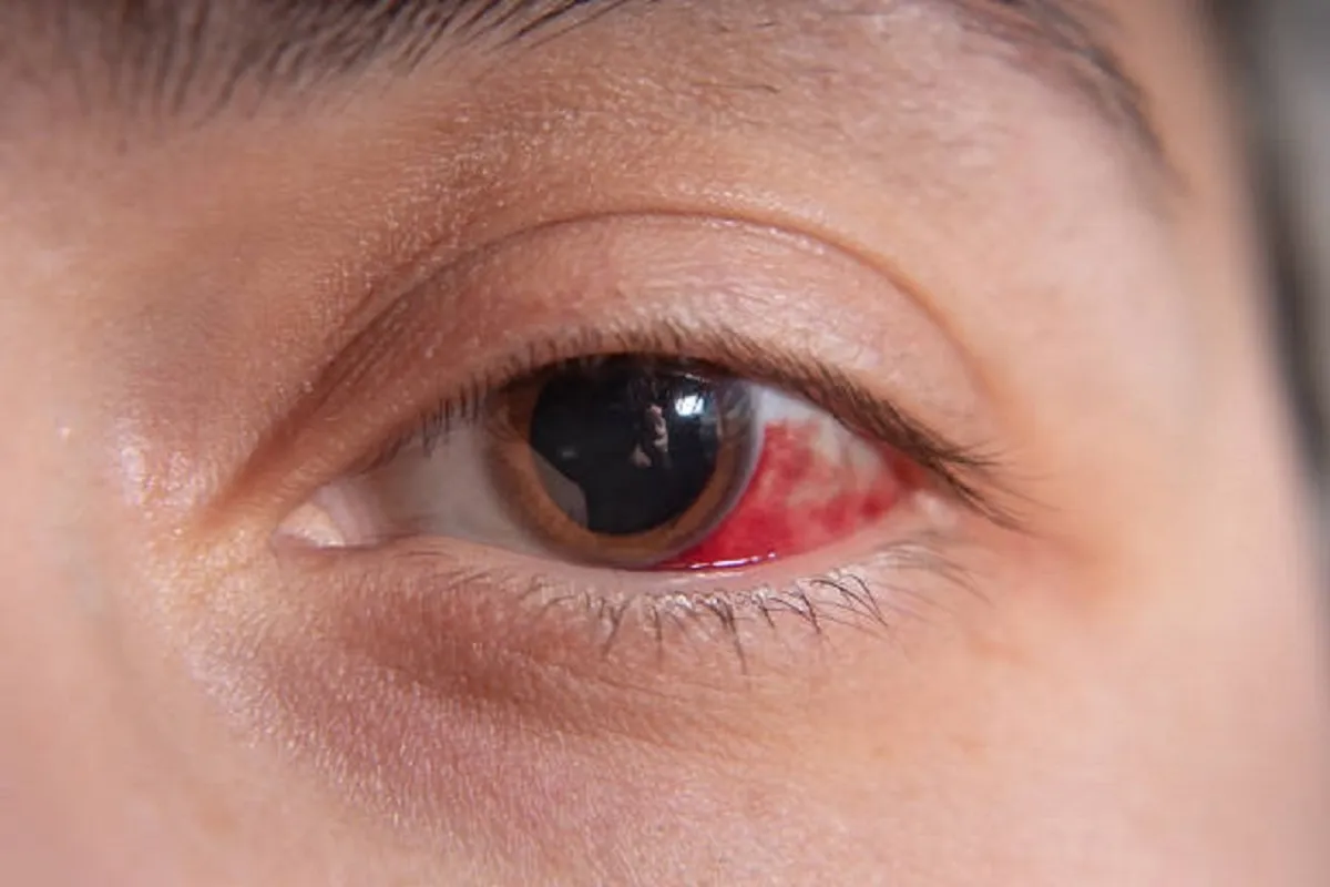احمرار العين (المصدر: Pexels )