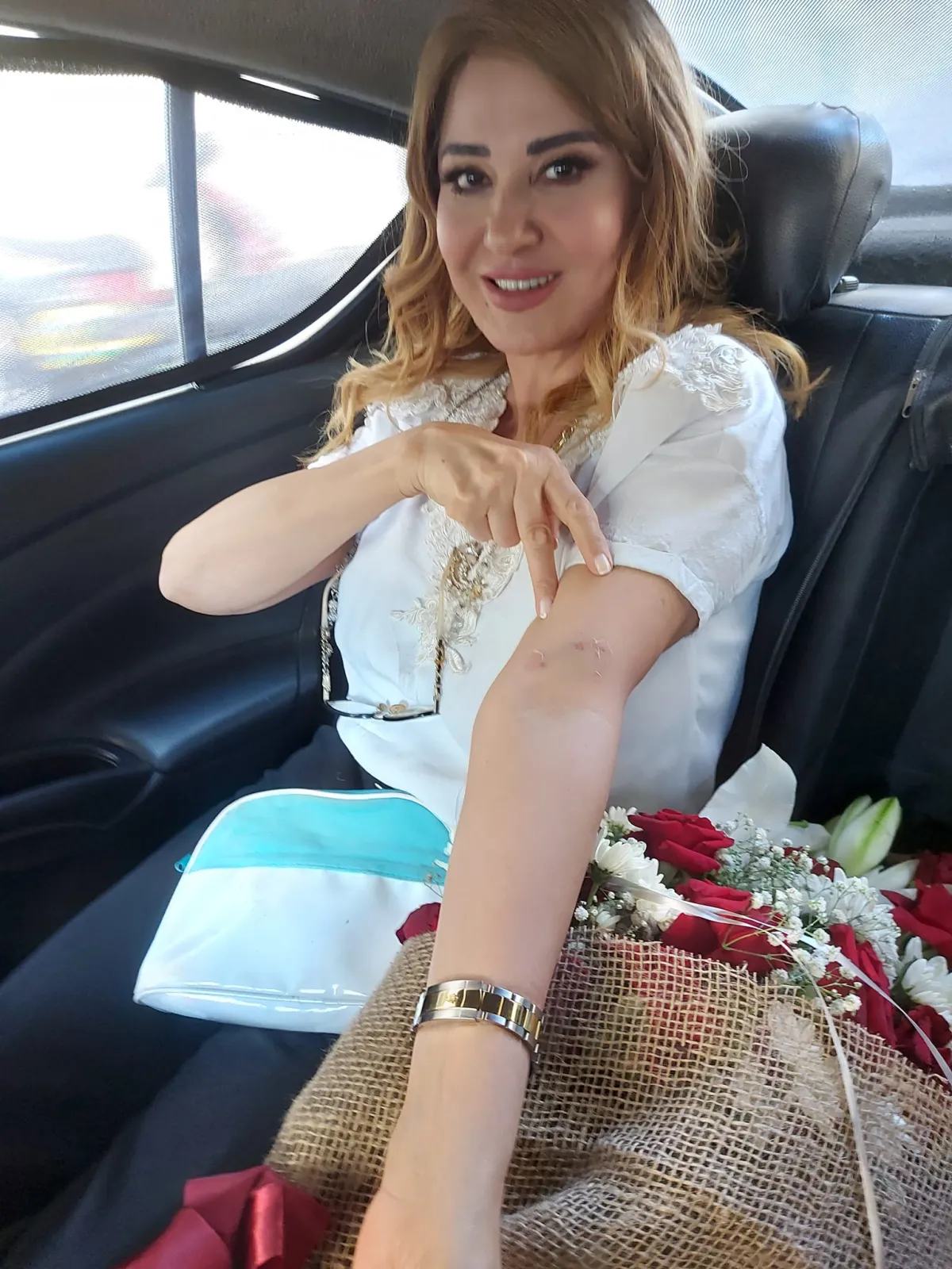 مادلين طبر تتعرض لعضة أسد في ذراعها الصورة من صفحتها الرسمية على فيسبوك