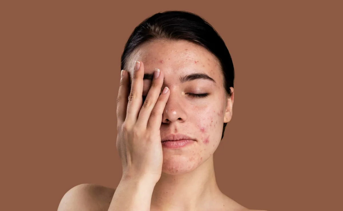 التخلص من ندبات الوجه