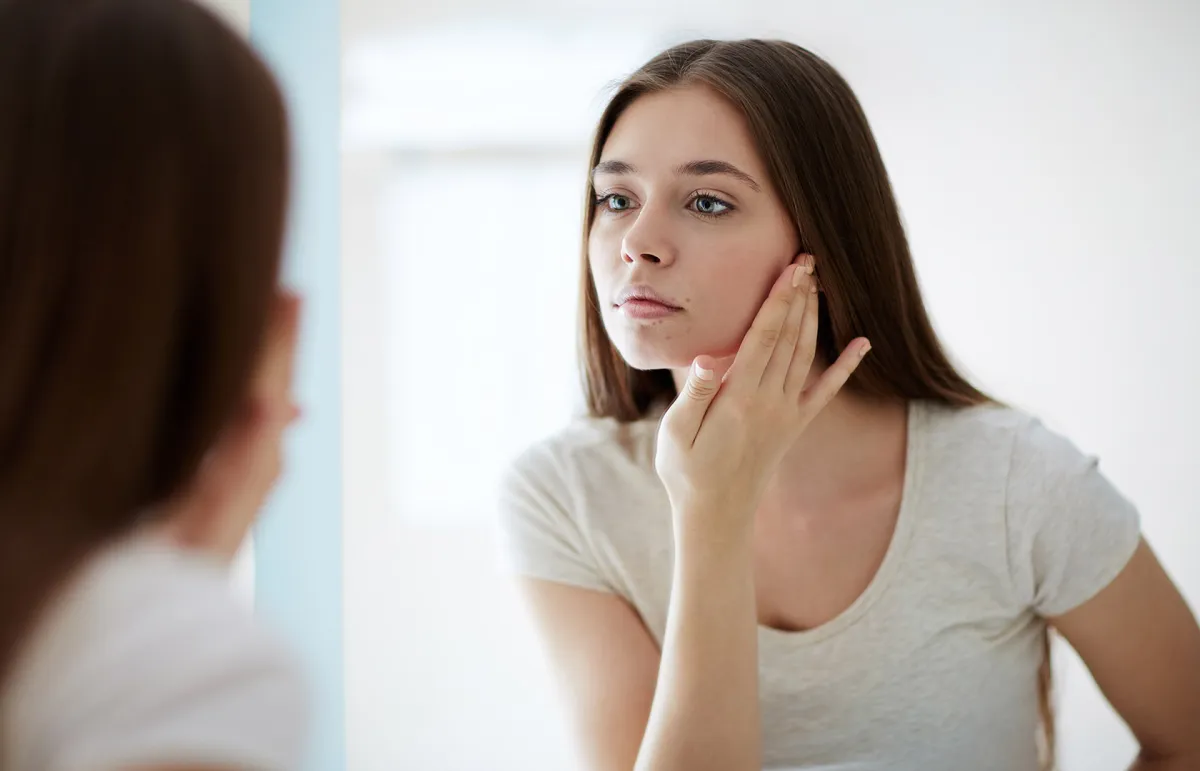 كيفية علاج حب الشباب حول الفم بطرق فعالة - Shutterstock