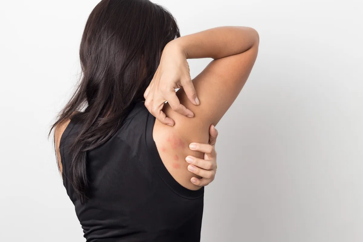 تبدأ الأعراض المبكرة لمرض لايم ما بين 3 إلى 30 يوماً بعد التعرض للدغة القراد المصاب (المصدر: Adobe.Stock)