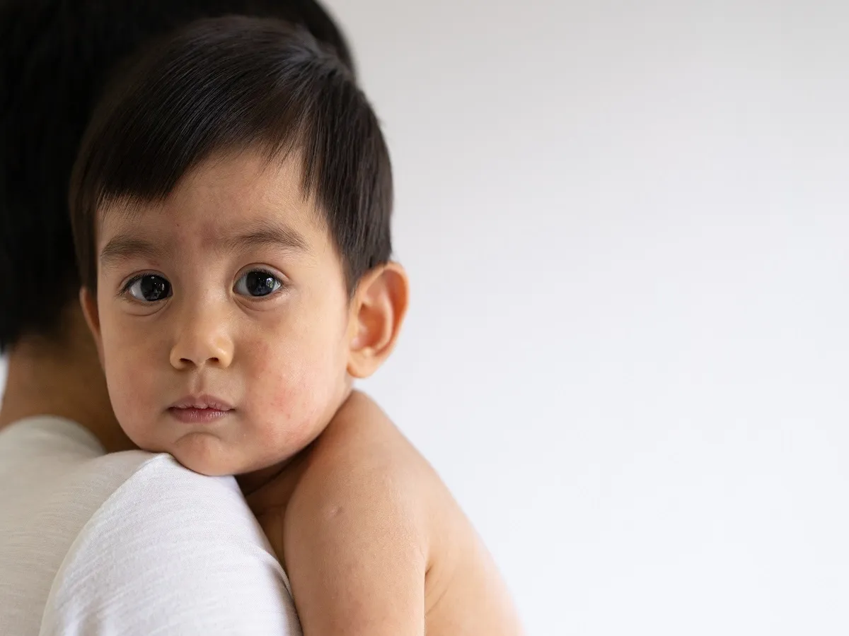 صورة لطفل مصاب بالطفح الجلدي