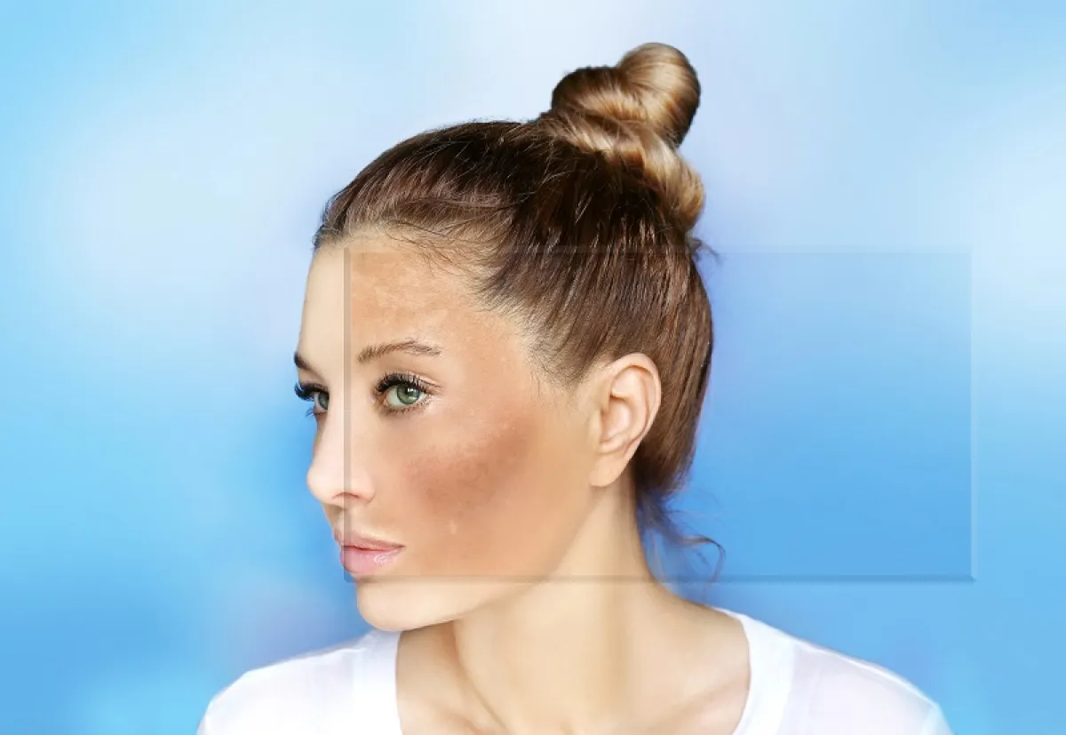 البقع الداكنة على البشرة