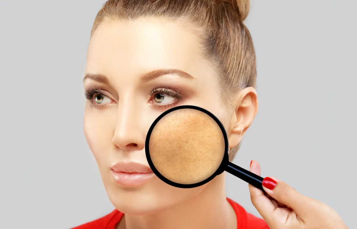 كيفية التخلص من البقع الداكنة على بشرتك