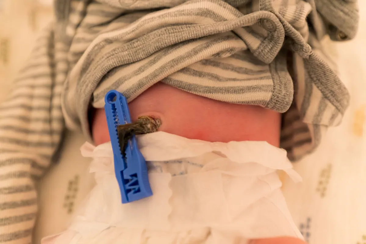 صورة تشير إلى السرة بعد جفافها وسقوط الحبل السري