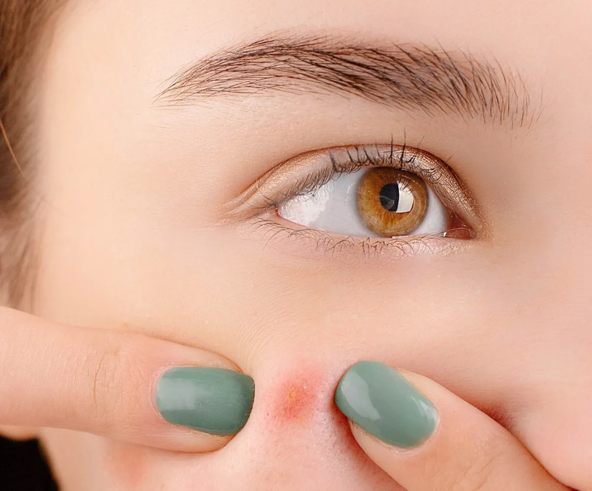 البثور التي لا تُشفى: إليك العلامات التي تشي بوجود السرطان(المصدر: Pexels)