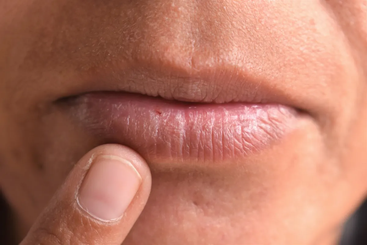 صورة لشفاه مشققة