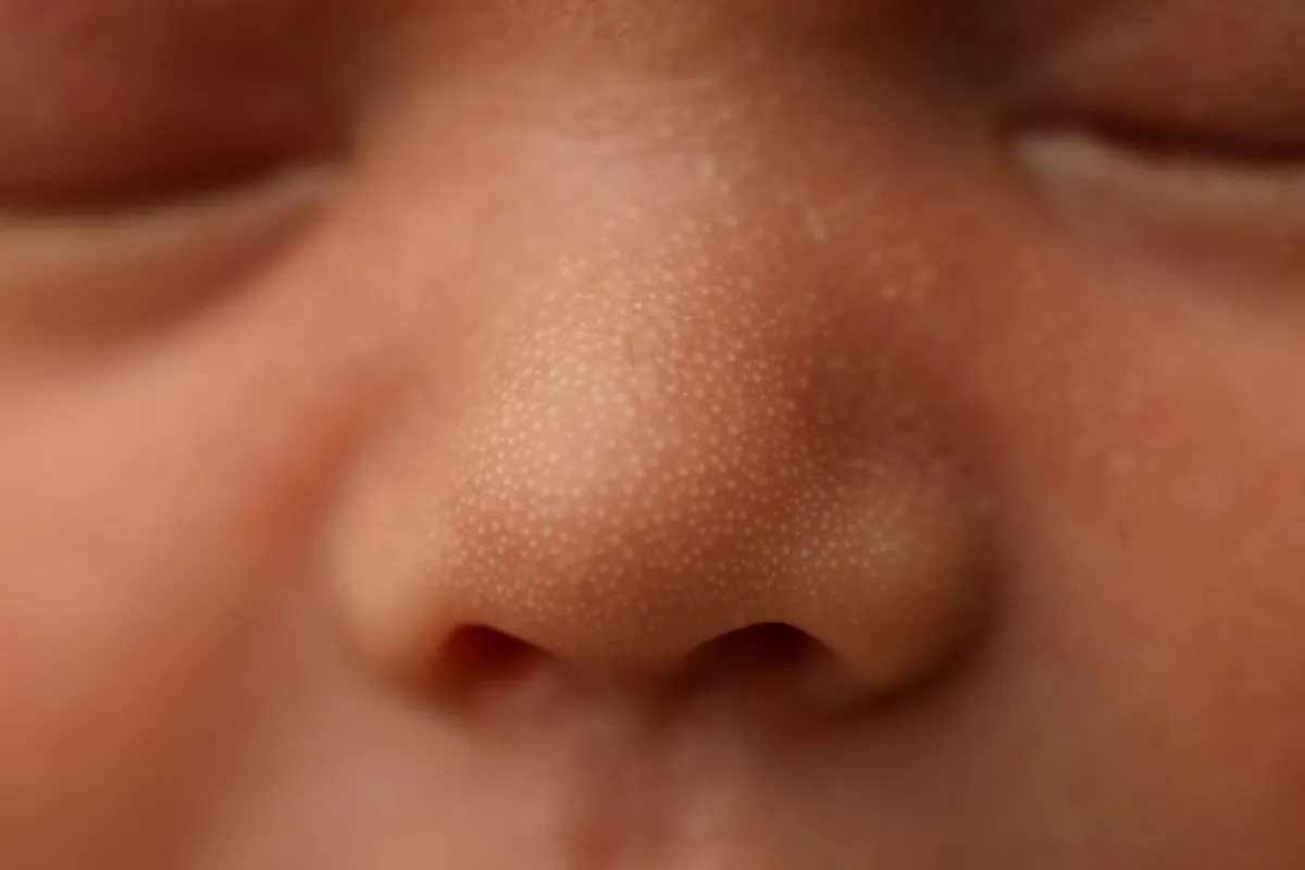 صورة توضح بعض البثور التي تزول تلقائياً دون علاج