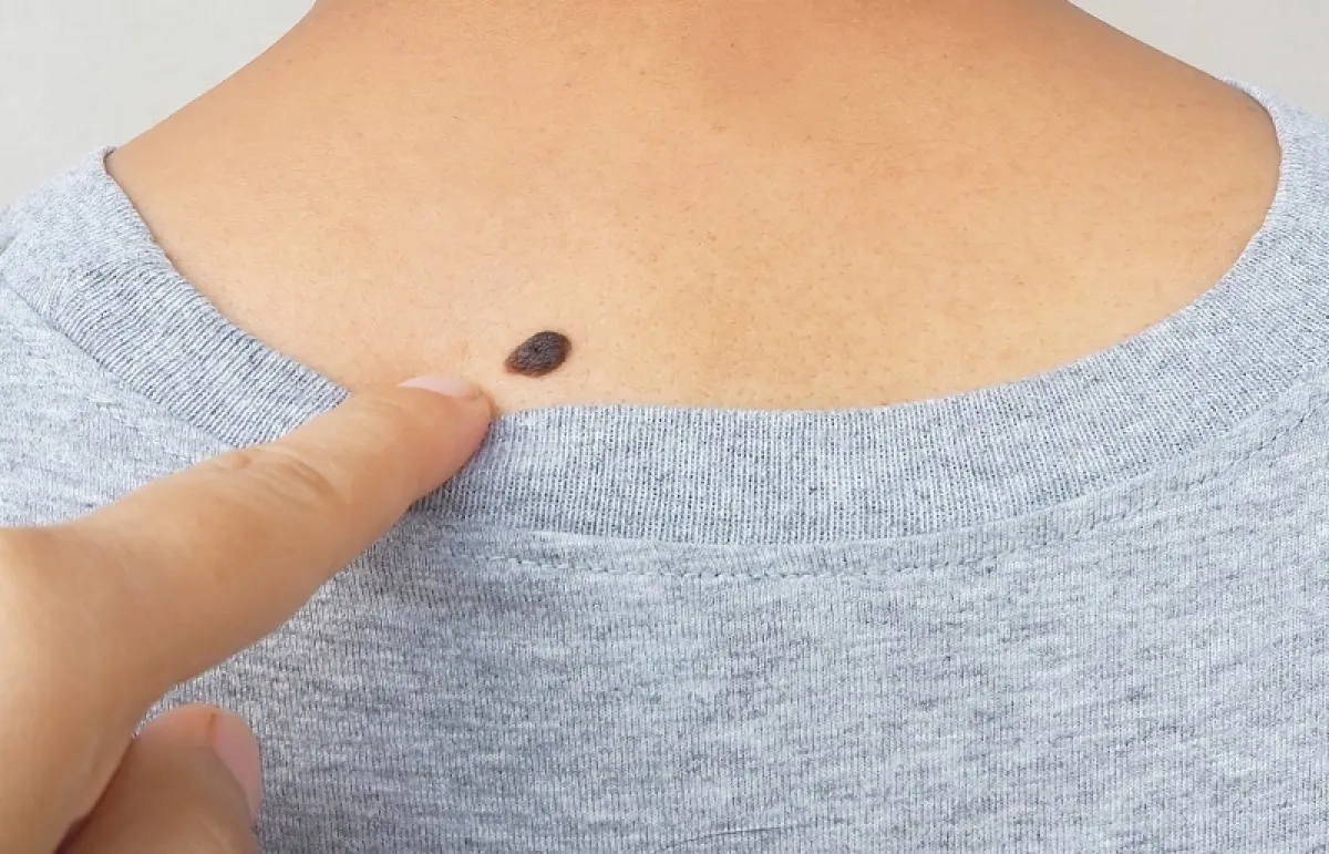 أنواع الشامات