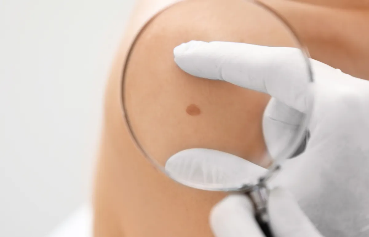 طرق إزالة الشامات بطرق تجميلية غير جراحية