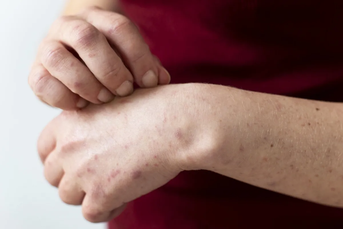 التغيرات في لون البشرة وجفاف الجلد من أبرز أعراض مرض جلد الفراشة (المصدر: Freepik)