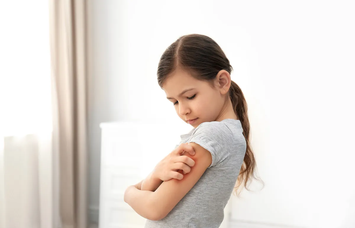 ما هو مرض جلد الفراشة؟.. اكتشفي أسباب وأعراض المرض - الصورة من Shutterstock 