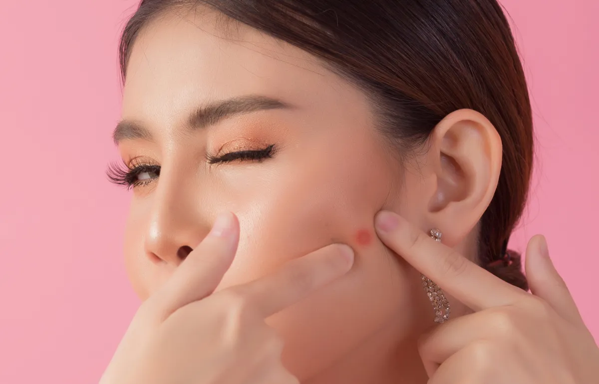 وصفات طبيعية للعروس للتخلص من آثار حب الشباب