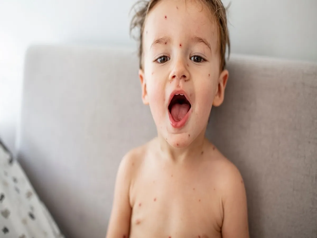 صورة لطفل مصاب بالجدري